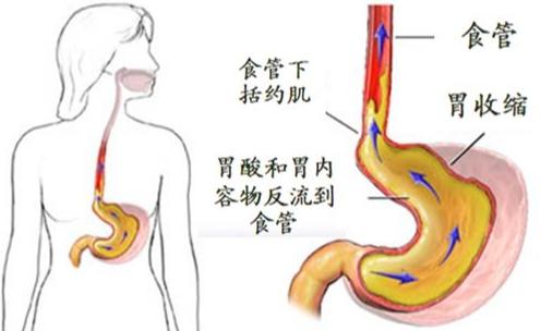 胃食管反流有哪些常见症状？ 1