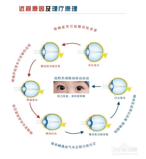 近视治疗：重塑清晰视界的有效方法 1