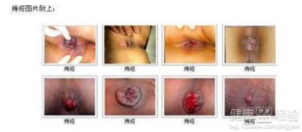 痔疮反复发作，如何找到根治之策？ 2
