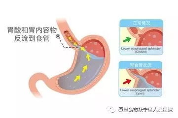胃食管反流有哪些常见症状？ 2