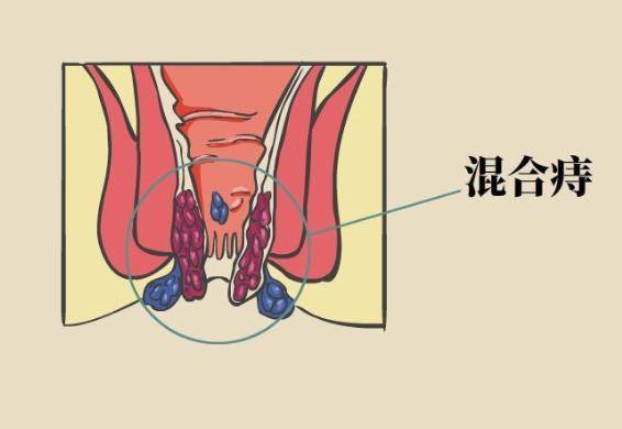 如何根治痔疮：最佳治疗方法 4