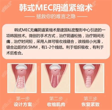 揭秘阴道紧缩术：重塑紧致，重拾自信！ 3