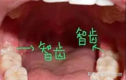 如何轻松辨识自己是否长了智齿？一看就懂的指南！ 1