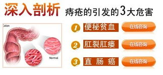 痔疮反复发作，如何找到根治之策？ 4