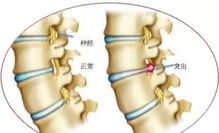 揭秘腰间盘突出的典型症状，你中招了吗？ 3