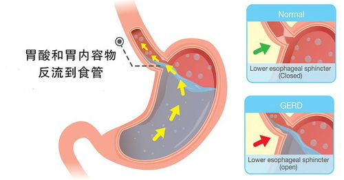 胃食管反流有哪些常见症状？ 3