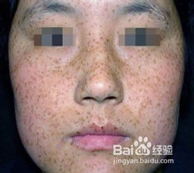 揭秘：高效去除雀斑的绝妙方法 1