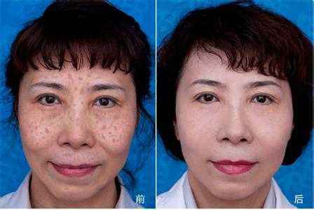 如何有效去除顽固色斑，重拾肌肤光彩？ 1