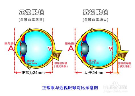 近视治疗：重塑清晰视界的有效方法 2