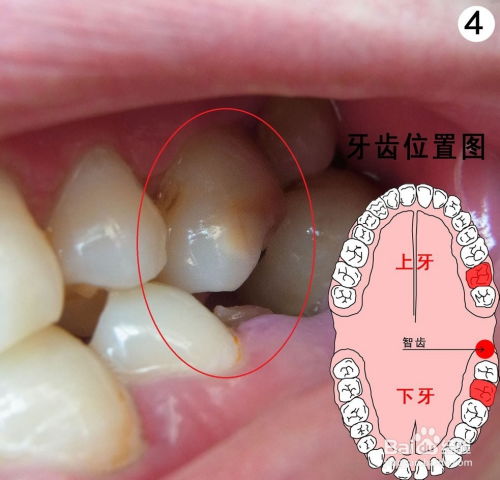 智齿来袭，牙龈肿痛如何轻松应对？专家支招，告别疼痛烦恼！ 4