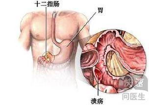 胃溃疡应该吃什么药治疗比较好？ 1