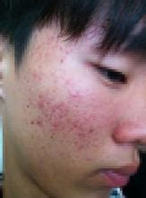 战胜青春痘：重拾肌肤自信秘籍 2